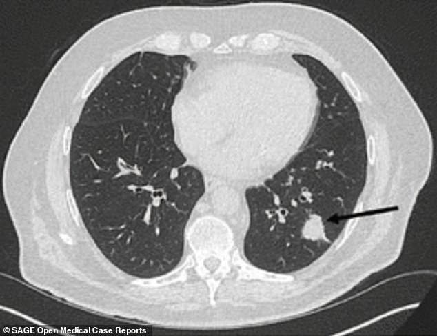 Read more about the article Striking scans show how ‘lung cancer patient’s tumours SHRANK within three months of him taking daily drops of cannabis-derived oil’